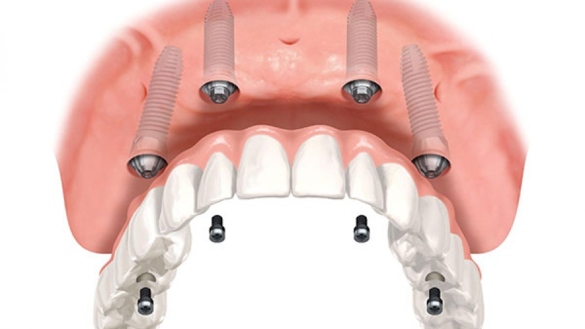 All-on-4 dental implants