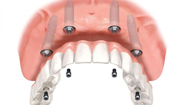All-on-4 Dental Implants: New Teeth in One Day