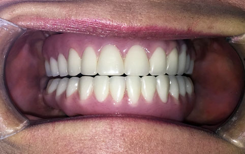 All on 4 dentalways patient with white teeth