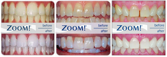 Zoom before and after