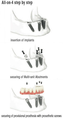 All-on-Four dental implant process
