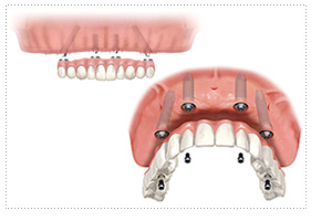 images all 4 implants 2