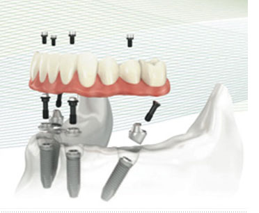 All-on-4 dental implants