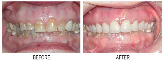 images before after 5 a
