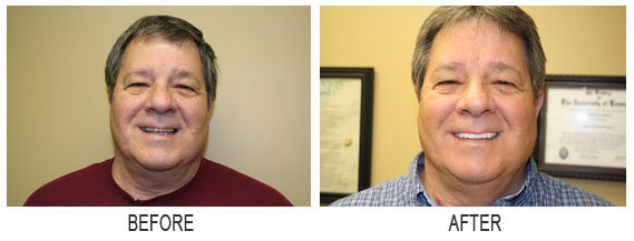 images before after 5