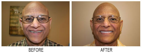 images before after 6