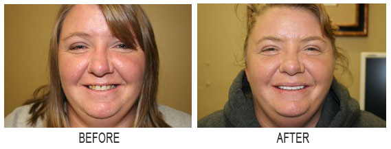 porcelain crowns dentist little rock