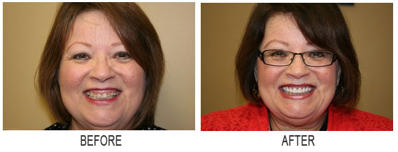 porcelaincrowns veneers1