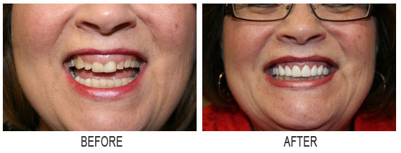 porcelaincrowns veneers2